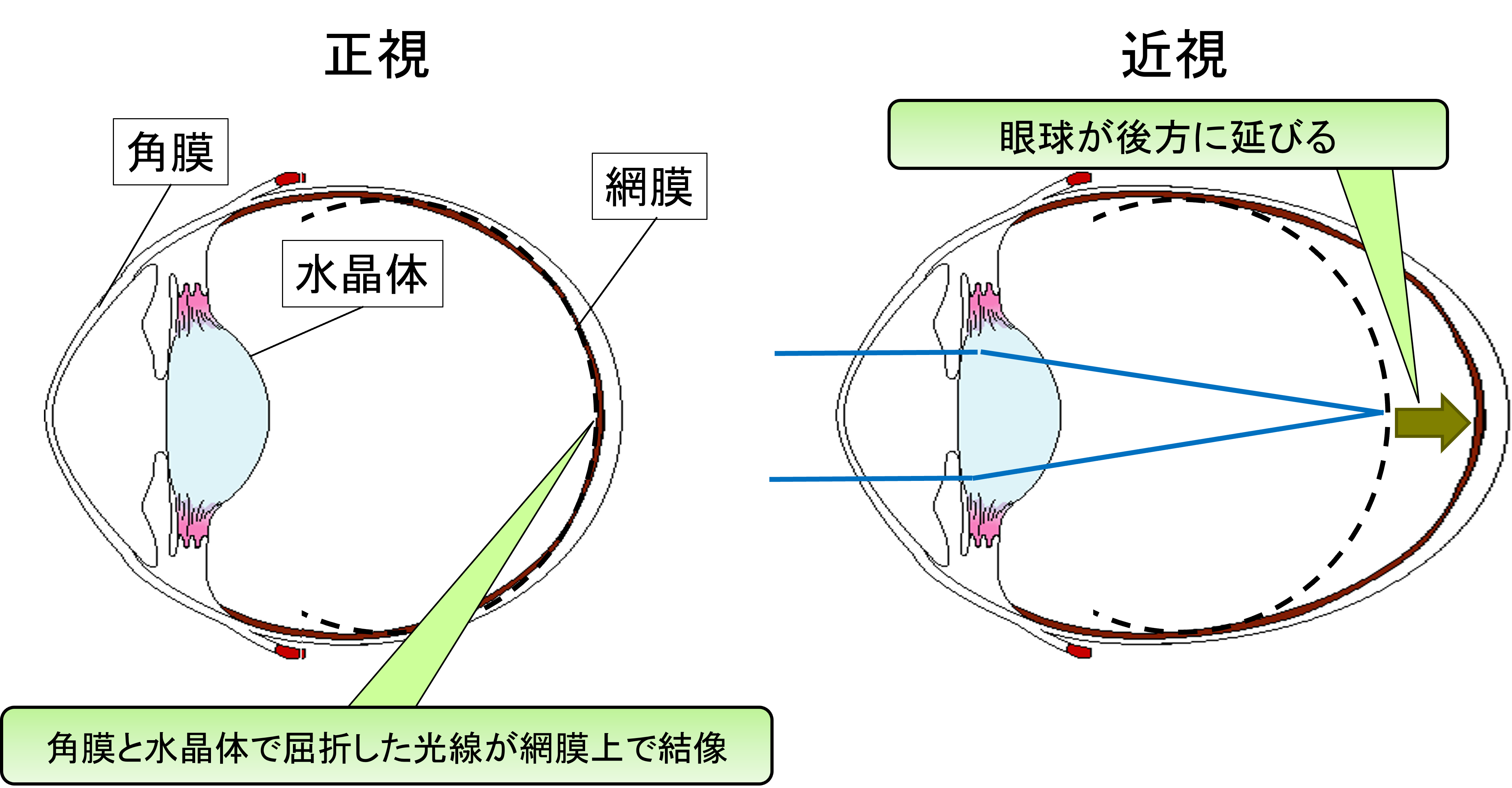 近視のメカニズムと子どもの視力を守るための習慣、海外における近視予防の事例